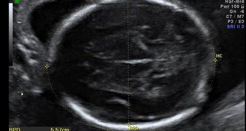 Intervalos de Referência das Medidas do Diâmetro Biparietal (DBP), da Circunferência Craniana (CC) e do Átrio do Ventrículo Lateral (VL)