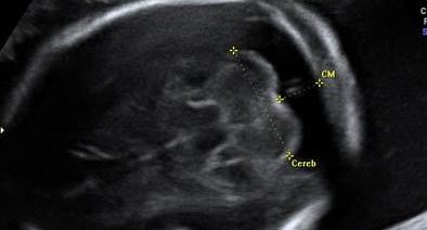 Intervalos de Referência das Medidas do Diâmetro Ântero-Posterior da Ponte e do Diâmetro Súpero-Inferior do Vérmice Cerebelar