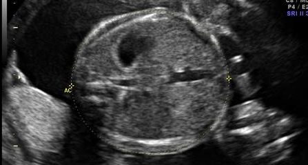 Ultrassom Abdome Fetal