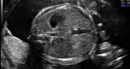 Intervalos de Referência da Circunferência Abdominal e Circunferência Torácica