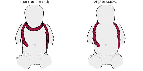 Cordão Enrolado no Pescoço - Circular de Cordão e Alça de Cordão