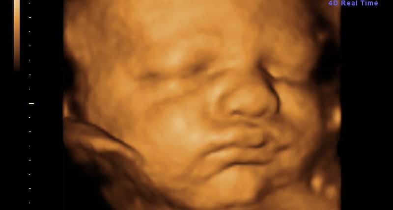 Ultrassom 3D face Fetal