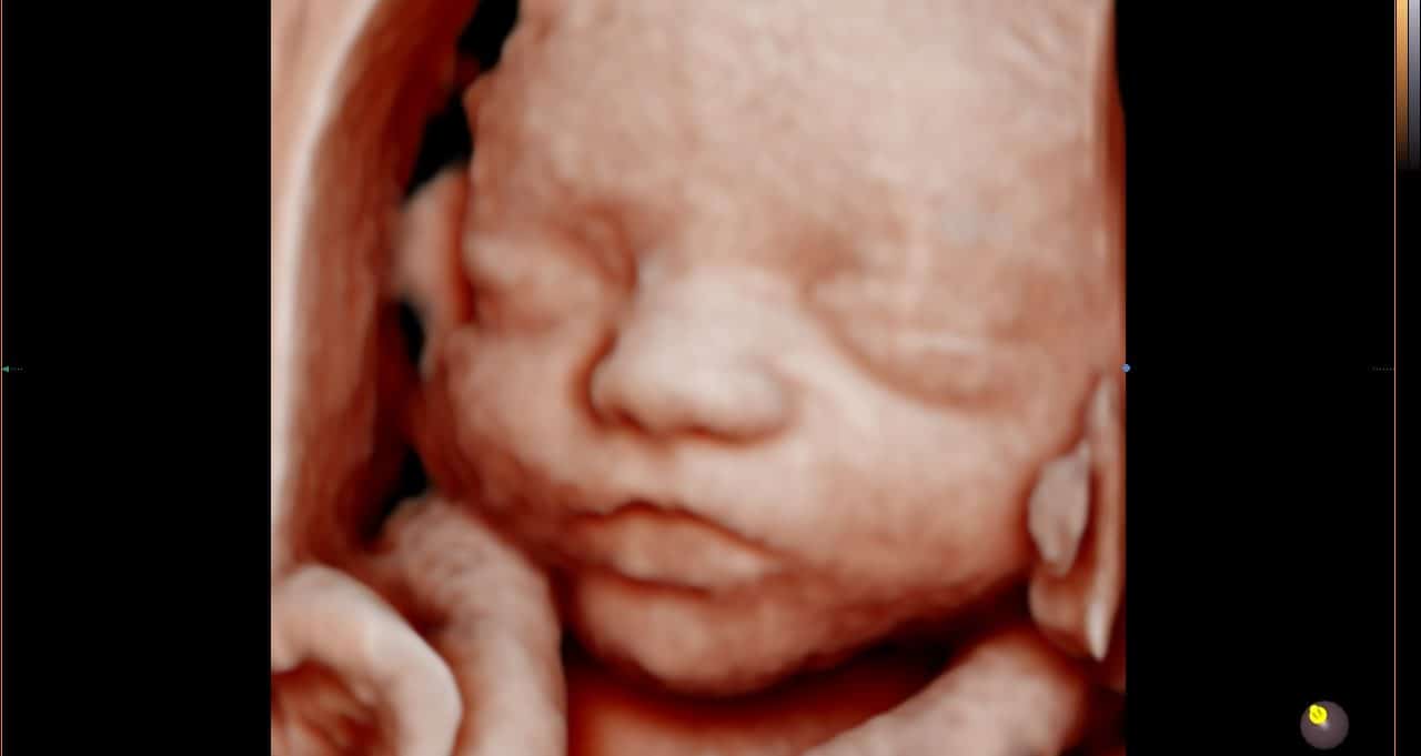 Ultrassom 3D face Fetal