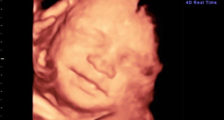 Ultrassom 3D face Fetal