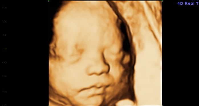 Ultrassom 3D face Fetal