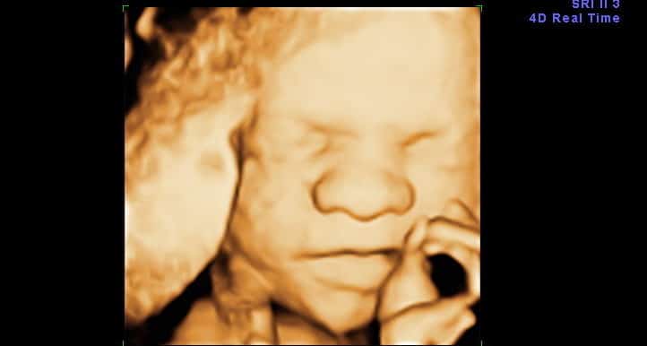 Ultrassom 3D face Bebe
