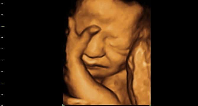 Ultrassom 3D face Fetal