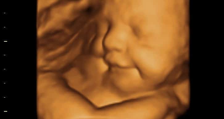 Ultrassom 3D face Fetal