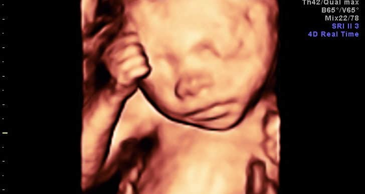 Ultrassom Face Fetal 3D