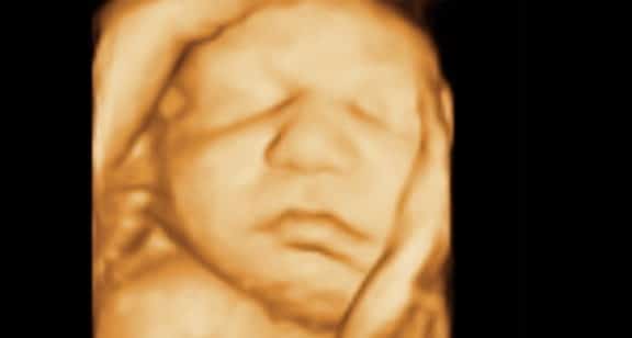 Face Fetal Ultrassom 3D