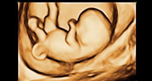 Ultrassom 3D de Embrião de 9 semanas