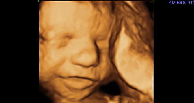 Ultrassom 3D face Fetal