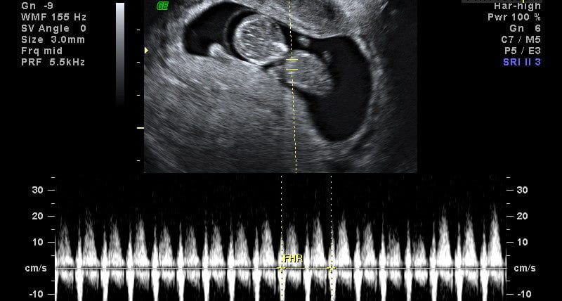 Batimento Cardíaco Embrião