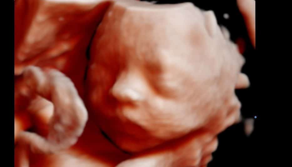 Ultrassom Face Fetal 3D