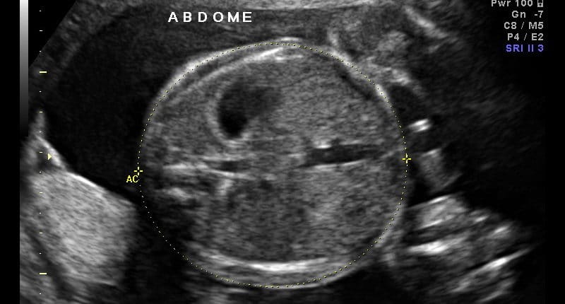 Ultrassom Medida do Abdômen Fetal
