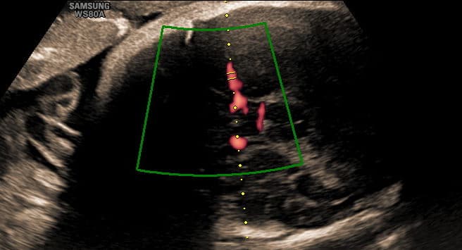 Intervalos de Referência para os Índices de Pulsatilidade da Artéria Cerebral Média e Intervalos de Referência para a Relação entre os Índices de Pulsatilidade das Artérias Cerebral Média e Umbilical