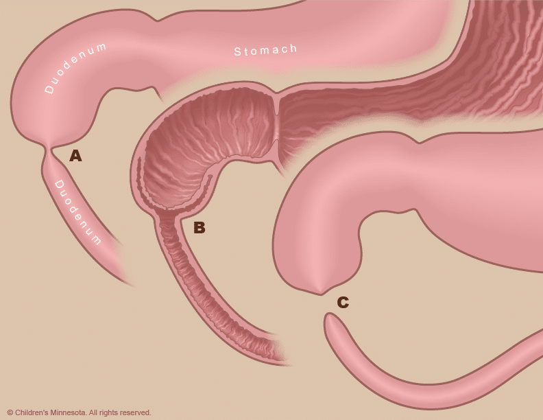 atresia duodenal