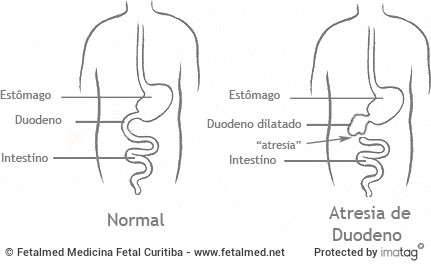 Esquema Atresia de Duodeno