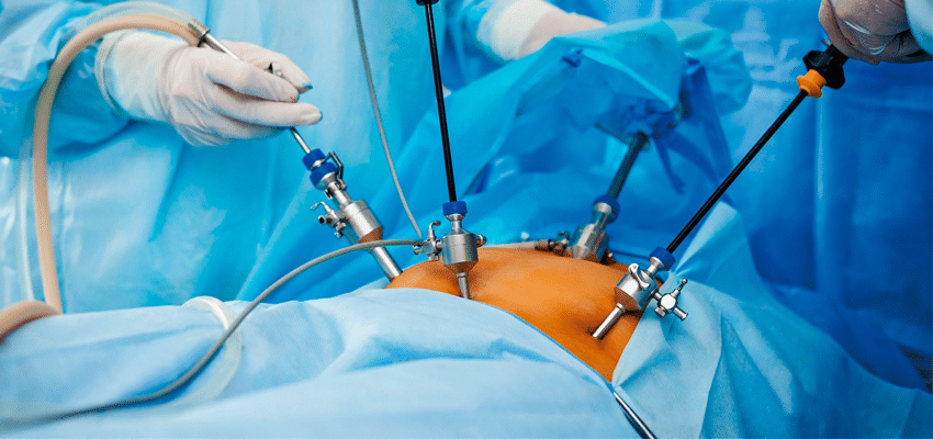 cirurgia laparoscopica