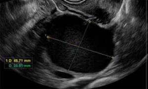 O que é cisto de ovário? | Fetalmed - Medicina Fetal em Curitiba
