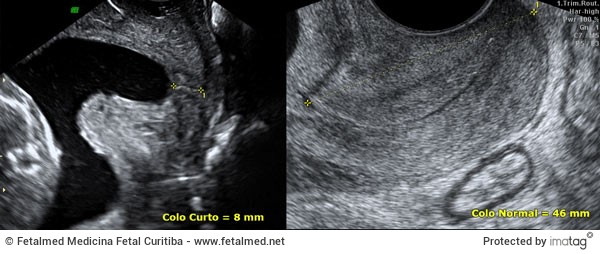 Colo Curto e Normal no Ultrassom