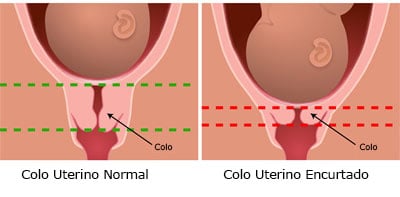 Colo Uterino Curto