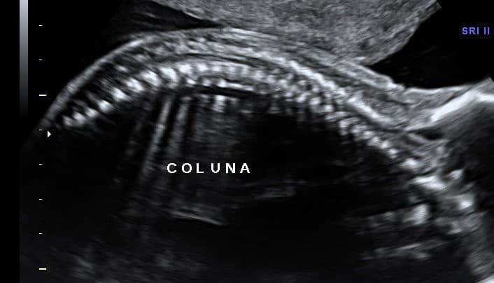 Ultrassom Coluna Fetal