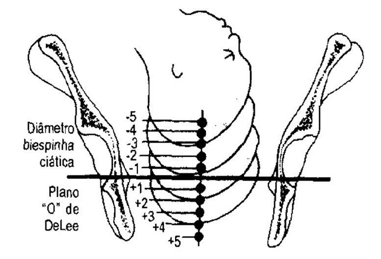 Diagnóstico da Altura e da Variedade da Apresentação do Polo Cefálico Fetal no Segundo Período do Trabalho de Parto com a Ultrassonografia Translabial