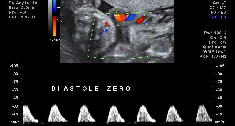 Ultrassom Doppler Artéria Umbilical