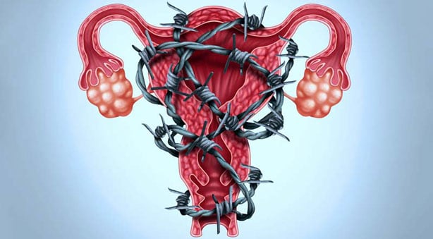 O que é endometriose?