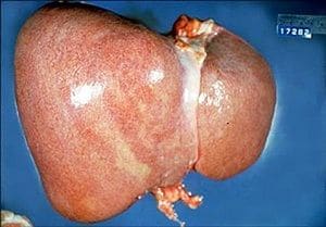 Fígado Gorduroso Agudo