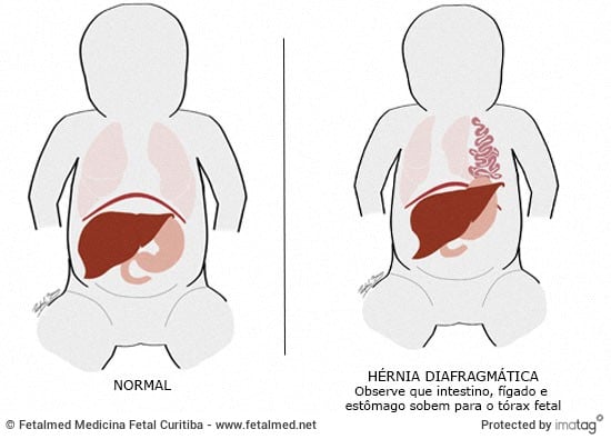 hérnia diafragmática
