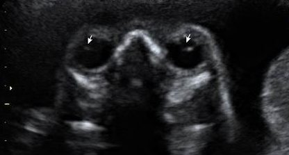 Ultrassom Cristalino Fetal