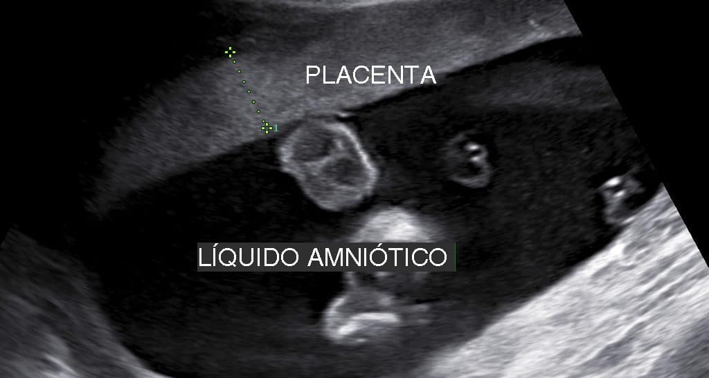 Ultrassom Medida Espessura Placenta