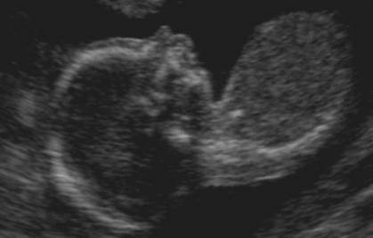 Micrognatia Fetal