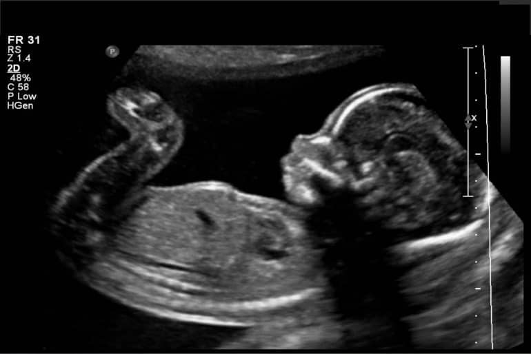 Perfil Fetal Ultrassom