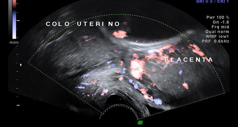 Ultrassom Placenta Prévia