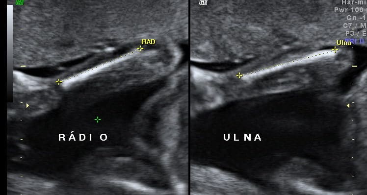 Ultrassom Osso Membro Superior