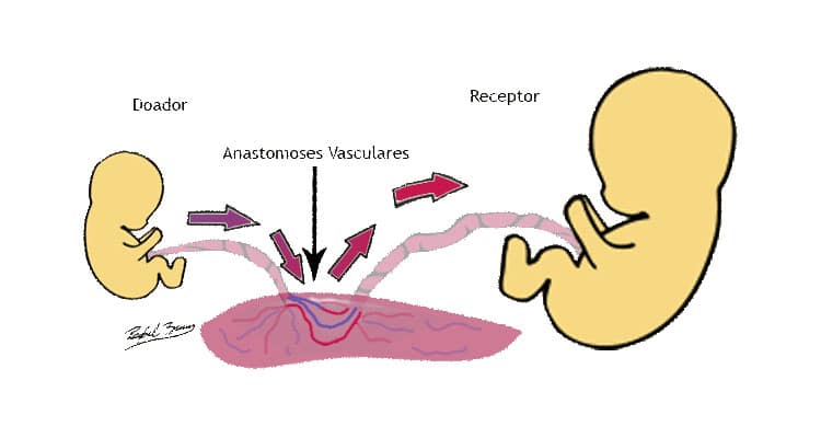 Transfusão Feto-Fetal