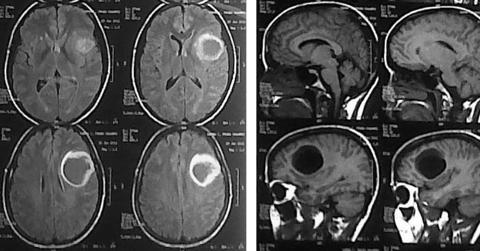 Glioblastoma