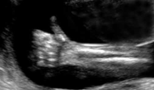 Anomalias das Mãos Observadas no Ultrassom entre 11 e 13 semanas