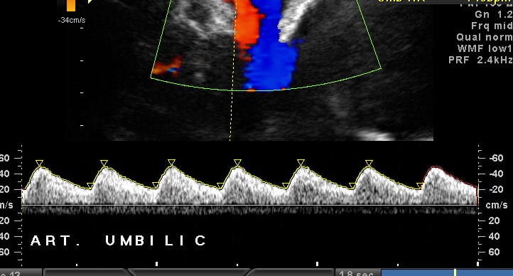 Doppler Artéria Umbilical