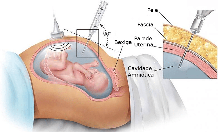 amniocentese