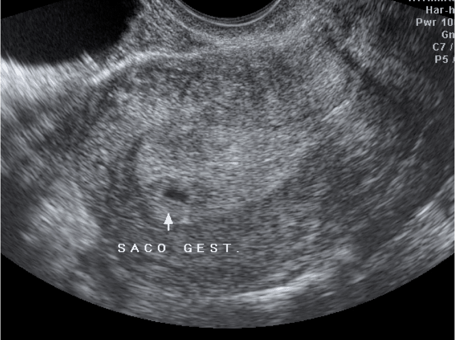 Ultrassom com 4 semanas de gestação