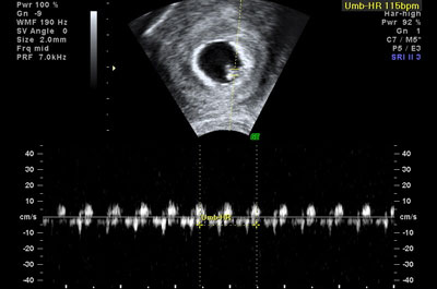 Frequência Cardíaca Fetal