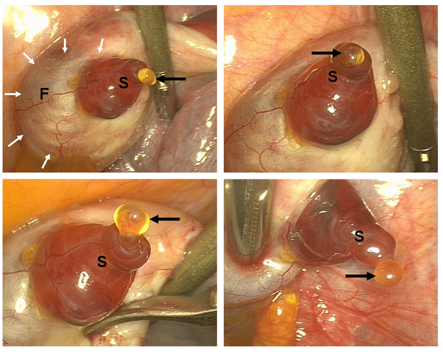 Ovulação Vista na Laparoscopia