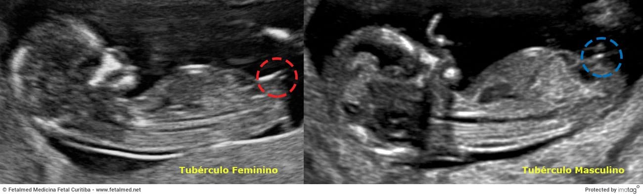 Sexo do Bebê - Posição do Tubérculo Genital