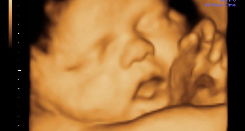 Face Fetal Ultrassom 3D