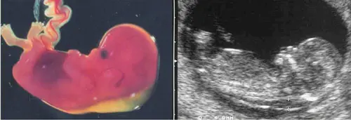 Medida da translucência nucal no ultrassom de primeiro trimestre — faixa translúcida na nuca do feto
