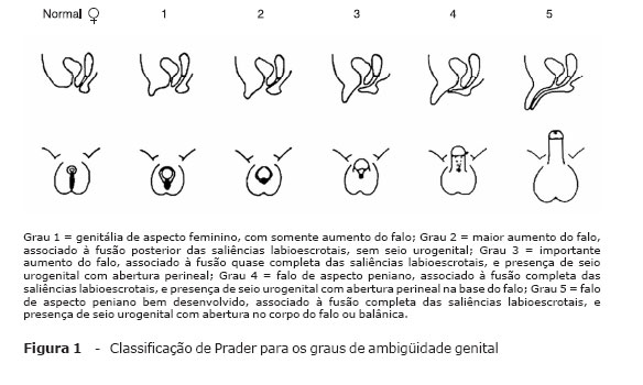 Classificacao Prader